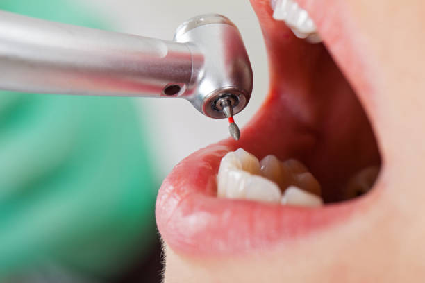 Best Knocked-Out Tooth (Avulsed Tooth) Treatment in Ridgefield, WA